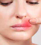 הרפס בשפתיים: מניעה וטיפול-תמונה